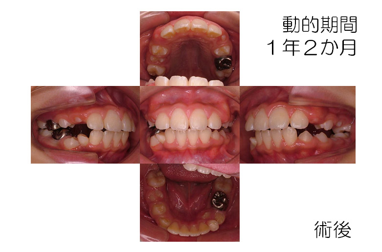 小児矯正 叢生 ガタガタ 症例に対する長期経過 やまもと小児歯科 矯正歯科クリニック