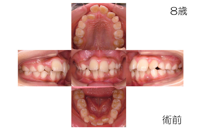 小児矯正 叢生 ガタガタ 症例に対する長期経過 やまもと小児歯科 矯正歯科クリニック